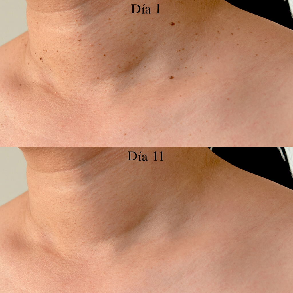 DermaClear Kit™ – Fin de las verrugas cutáneas