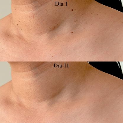 DermaClear Kit™ – Fin de las verrugas cutáneas
